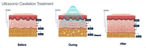 fat cavitation northbridge|Efficacy of Ultrasound for Localized Fat Treatment on Clinical and .